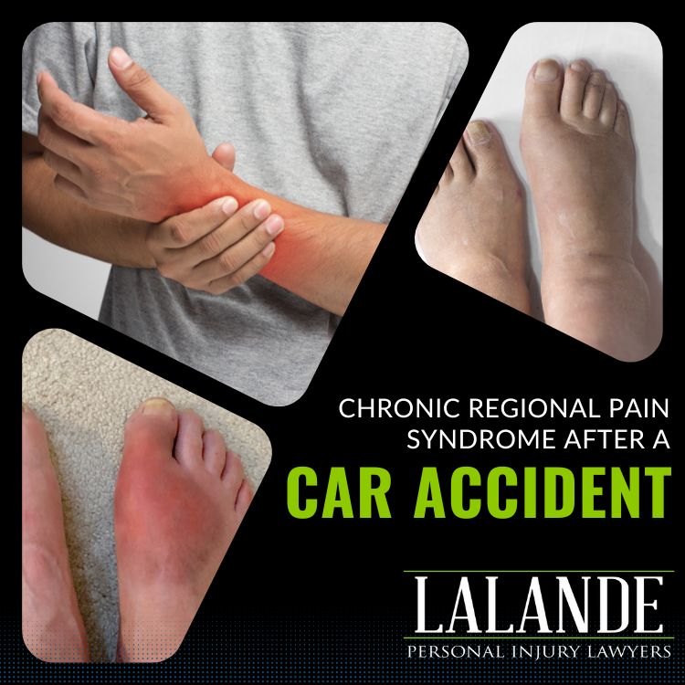 Complex Regional Pain Syndrome (CRPS) after a Car Accident
