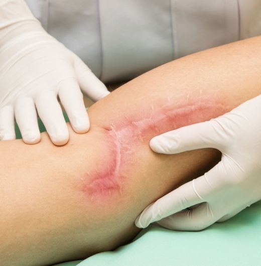 compensation for traumatic scarring cta