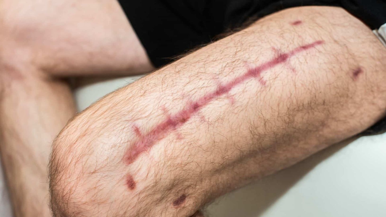 The psychologiocal and emotional impact of traumatic scarring